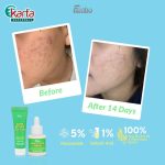 FANBO Skin Goals Acne Rescue Club (STEP 3 OF ACNE TREATMENT)